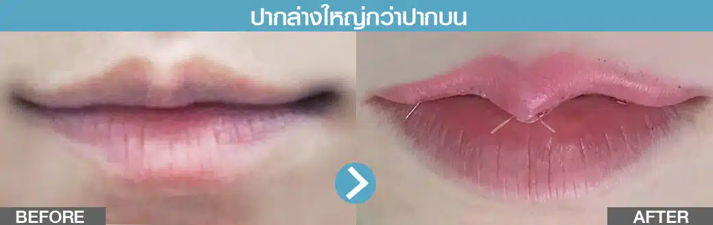 รีวิวปากกระจับ ปากล่างใหญ่กว่าปากบน