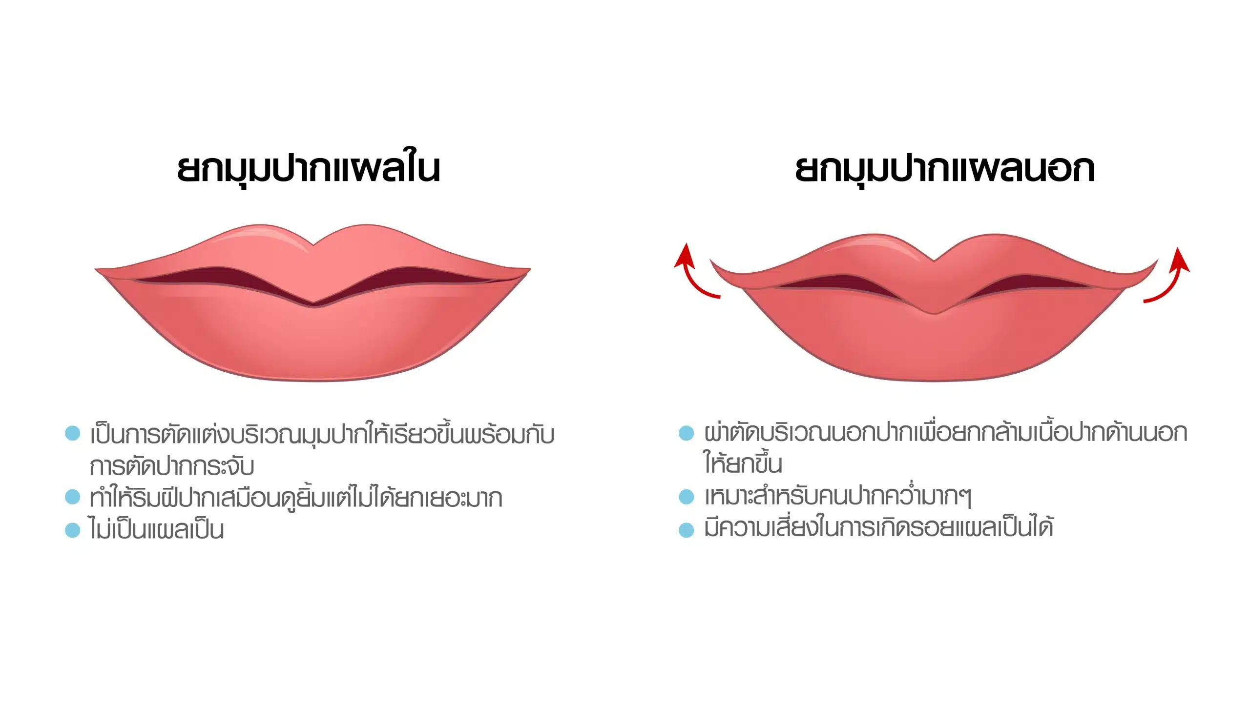 ยกมุมปากแผลใน ยกมุมปากแผลนอก