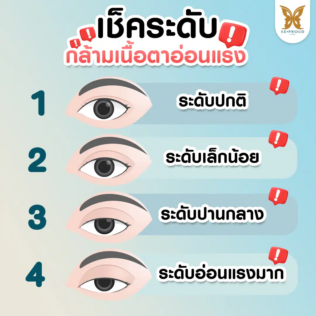 เช็คระดับกล้ามเนื้อตาอ่อนแรง