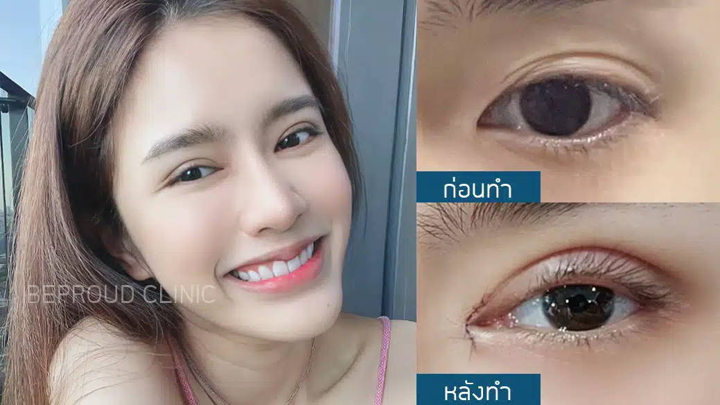 เทคนิคการเปิดหัวตา