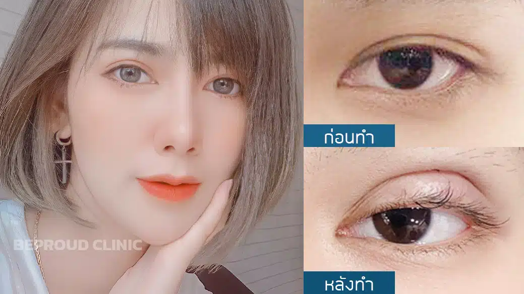 ตาสองชั้นแผลมินิ