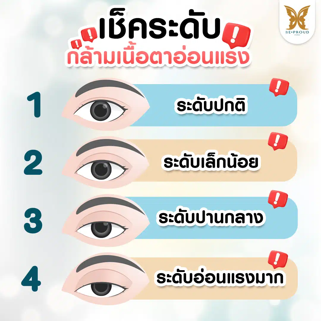 ระดับกล้ามเนื้อตาอ่อนแรง